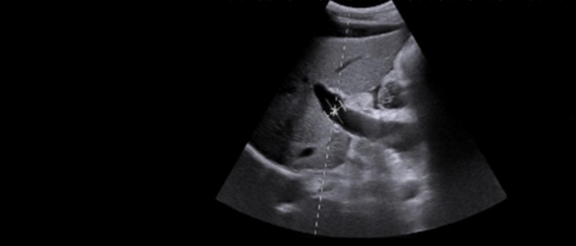 BASL hepatology BASL hepatology